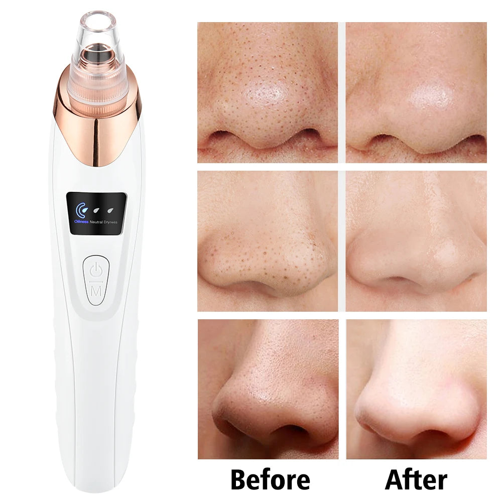 Blackhead Remover Vacuum Suction USB Rechargeable Facial Pore Cleaner Comedone Spot Acne Pimple Black Head Extractor Care Tools