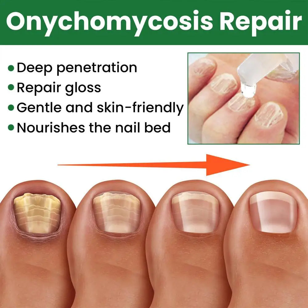 Toenail Anti-infective Nail Repair Solution Gel Hand Foot Nails Care Fungu Removal Nail Repair Drops Restoring Healthy Nails