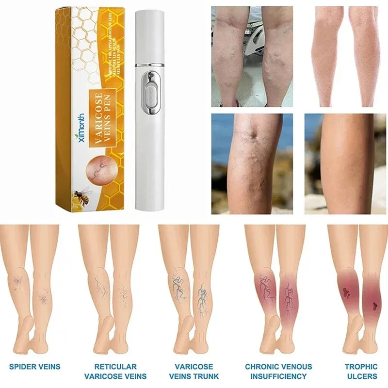 Laser Veins Varicose Pen Reduce Legs Imcomfortable Improve Blood Circulation Laser Therapy Varicose Veins Pen Skin Care Product