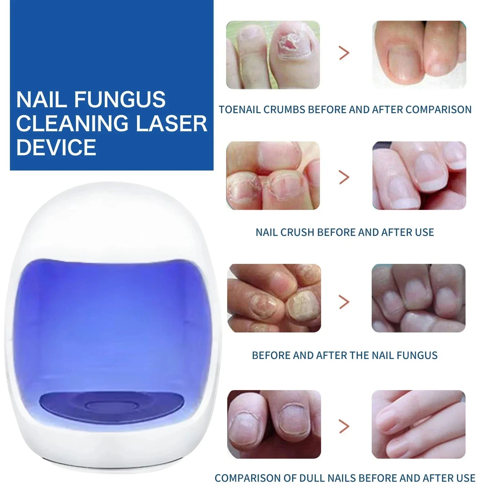 Xiaomi Toenail Nail Fungus Treatment Repair Fingernail Device Toenail Treatment for Foot Nail Fungus Essential Oil Onychomycosis