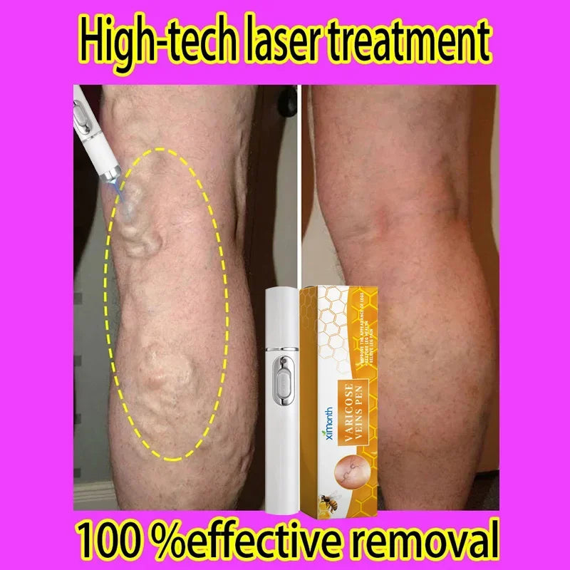 Laser Veins Varicose Pen Reduce Legs Imcomfortable Improve Blood Circulation Laser Therapy Varicose Veins Pen Skin Care Product