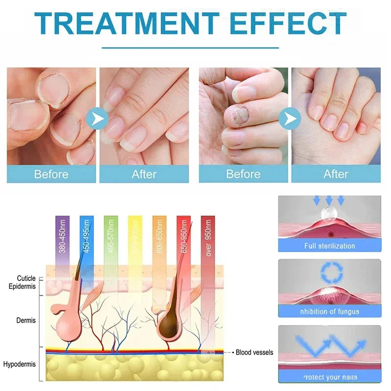 Xiaomi Toenail Nail Fungus Treatment Repair Fingernail Device Toenail Treatment for Foot Nail Fungus Essential Oil Onychomycosis