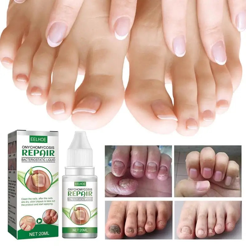 Toenail Anti-infective Nail Repair Solution Gel Hand Foot Nails Care Fungu Removal Nail Repair Drops Restoring Healthy Nails