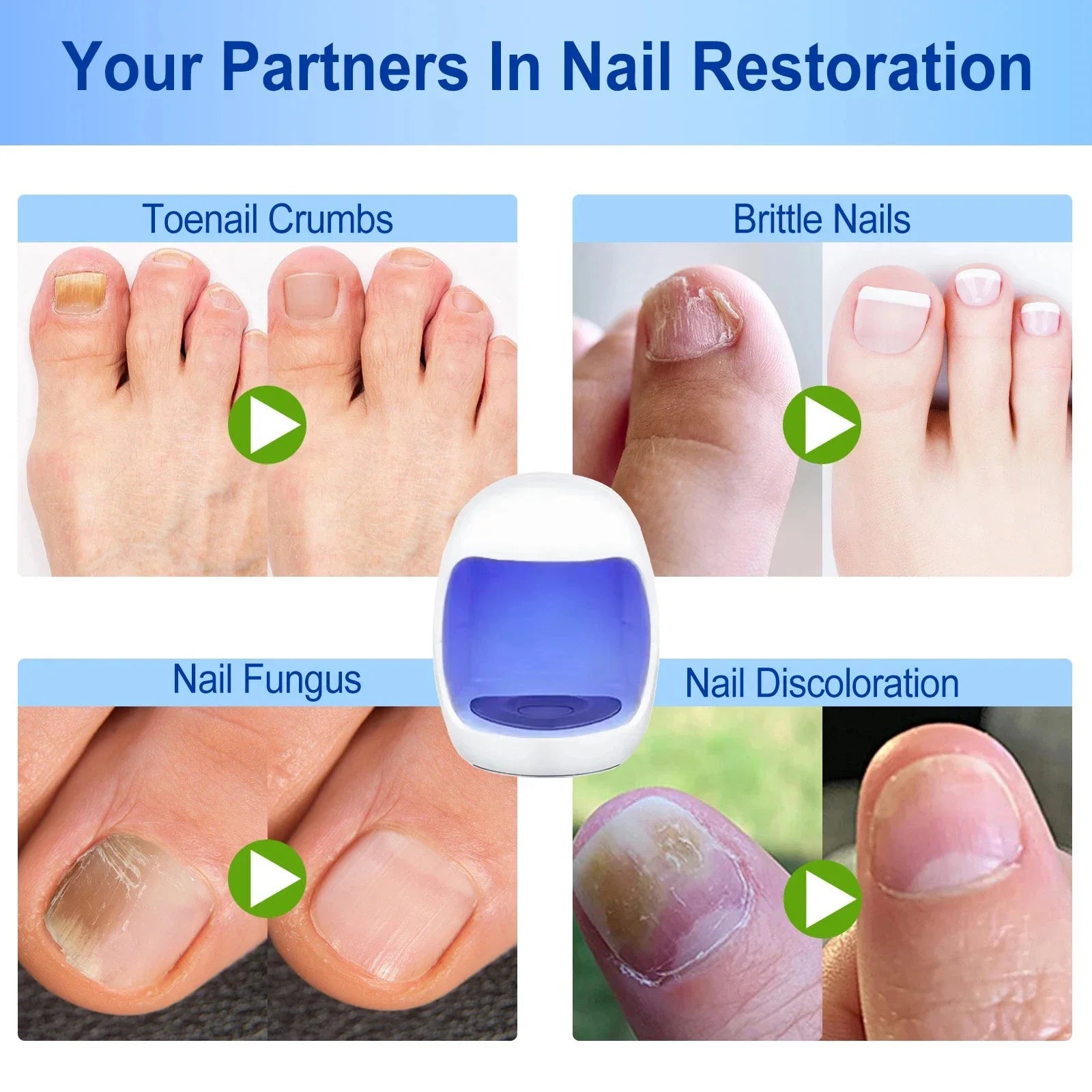 Xiaomi Toenail Nail Fungus Treatment Repair Fingernail Device Toenail Treatment for Foot Nail Fungus Essential Oil Onychomycosis