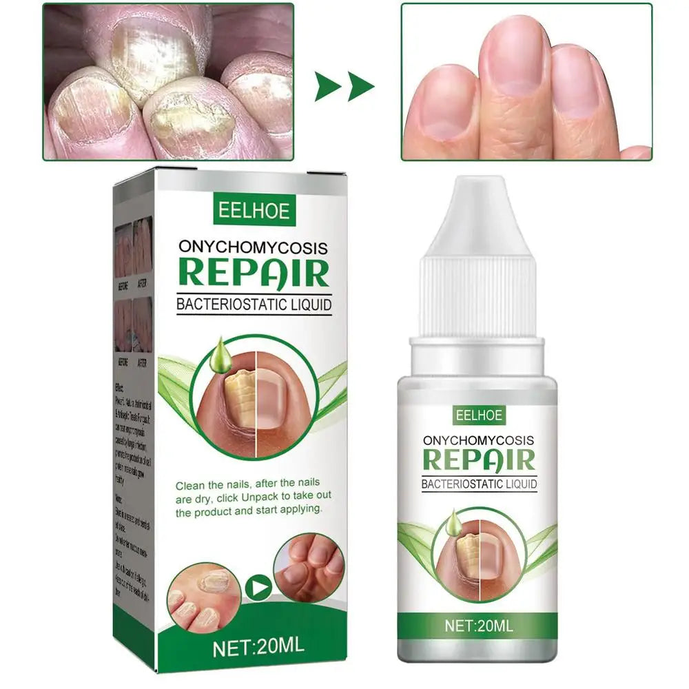 Toenail Anti-infective Nail Repair Solution Gel Hand Foot Nails Care Fungu Removal Nail Repair Drops Restoring Healthy Nails