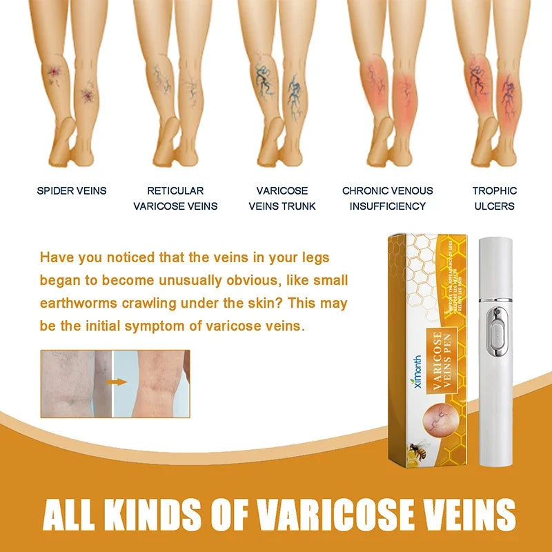 Laser Veins Varicose Pen Reduce Legs Imcomfortable Improve Blood Circulation Laser Therapy Varicose Veins Pen Skin Care Product