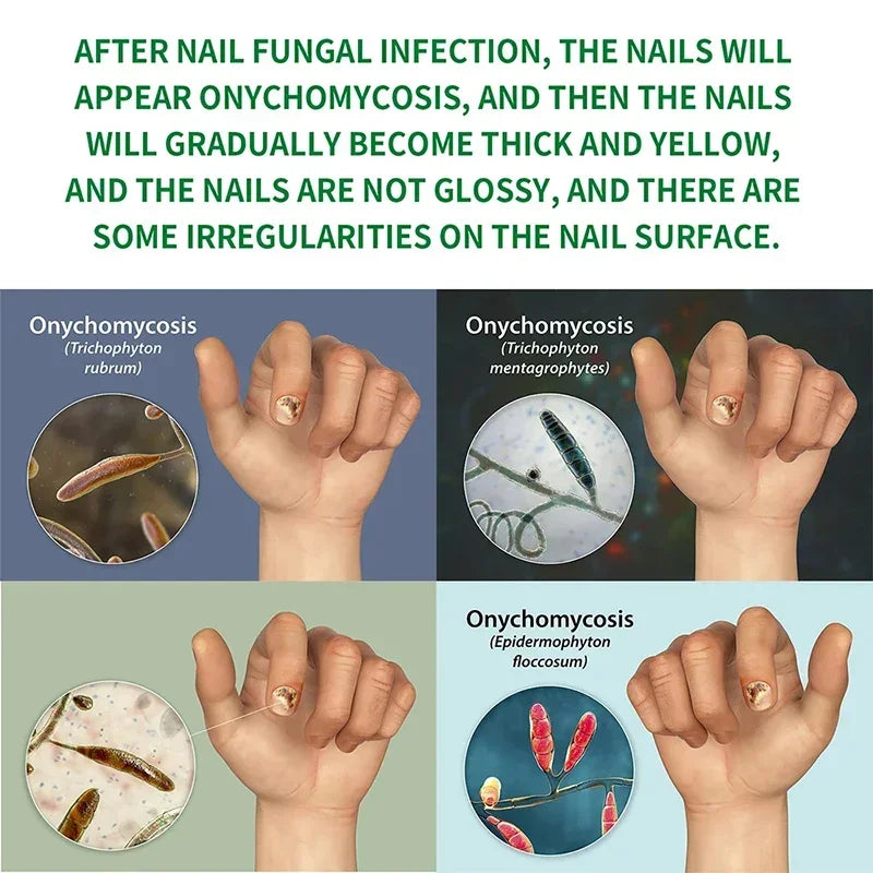 Xiaomi Toenail Nail Fungus Treatment Repair Fingernail Device Toenail Treatment for Foot Nail Fungus Essential Oil Onychomycosis